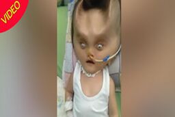 تغییر شکل عجیب صورت نوزاد پس از عمل جراحی!