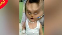 تغییر شکل عجیب صورت نوزاد پس از عمل جراحی!