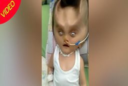 تغییر شکل عجیب صورت نوزاد پس از عمل جراحی!