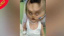 تغییر شکل عجیب صورت نوزاد پس از عمل جراحی!