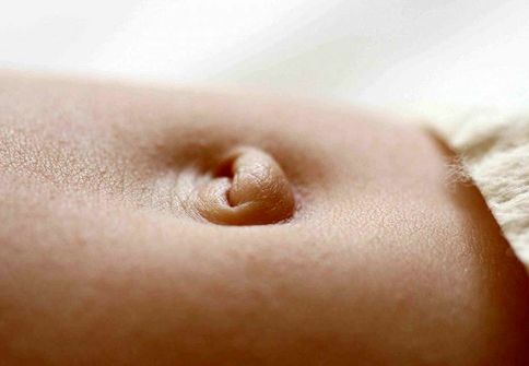 فتق ناف در نوزادان؛ چه زمانی بهبود می‌یابد؟