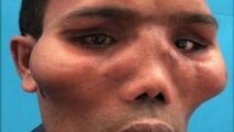 تغییر شکل عجیب صورت مرد جوان در اثر یک عارضه نادر!