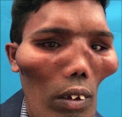 تغییر شکل عجیب صورت مرد جوان در اثر یک عارضه نادر!