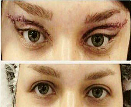 جراحی به اصطلاح زیبایی گوش الاغی و چشم گربه‌ای!