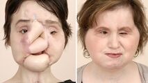 عمل پیوند صورت، دختر جوان را به زندگی عادی برگرداند