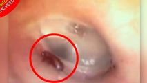 لحظه خارج کردن مورچه از گوش بیمار!
