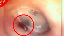 لحظه خارج کردن مورچه از گوش بیمار!