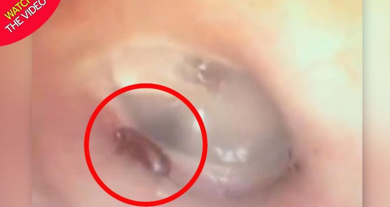 لحظه خارج کردن مورچه از گوش بیمار!