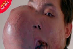 تغییر شکل عجیب صورت مرد جوان در اثر تومور وحشتناک!